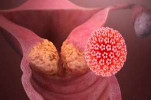ویروس HPV احتمال مرگ قلبی زنان را افزایش می دهد