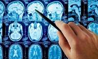 ویروسی که منجر به آلزایمر می شود